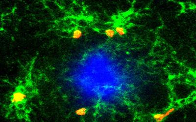 Alzheimer: Cientistas negam que a doena cause perda de neurnios e sinapses