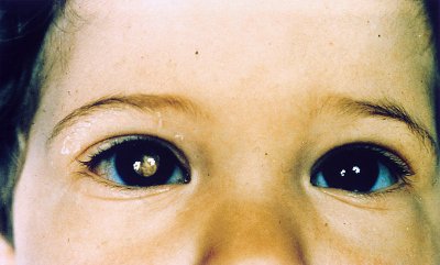 Retinoblastoma: Diagnstico precoce pode salvar viso de crianas