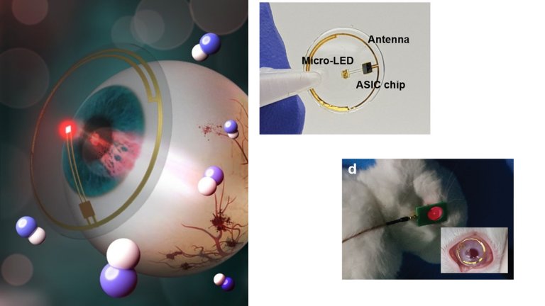 Lentes de contato com LEDs evitam retinopatia diabtica