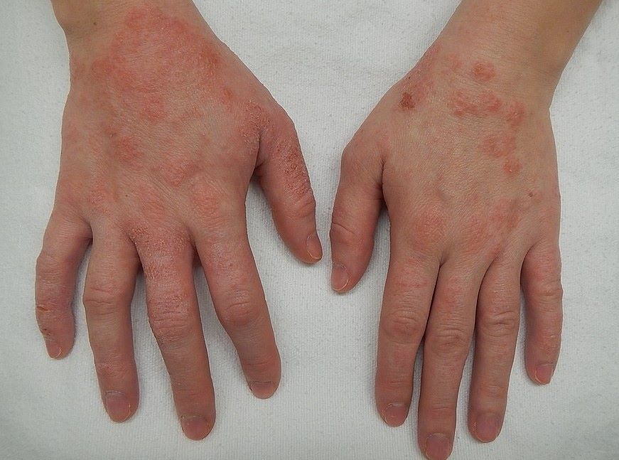 Conexo intestino-pele  fator central na dermatite atpica