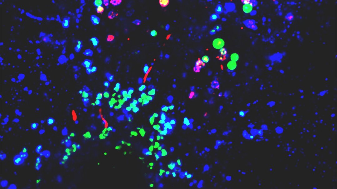 Nanoplsticos promovem condies para desenvolvimento da doena de Parkinson