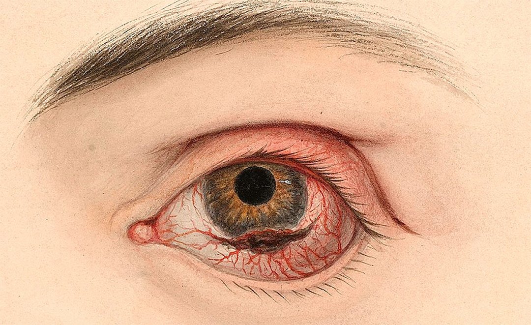 Tratamento com laser poder erradicar melanoma ocular