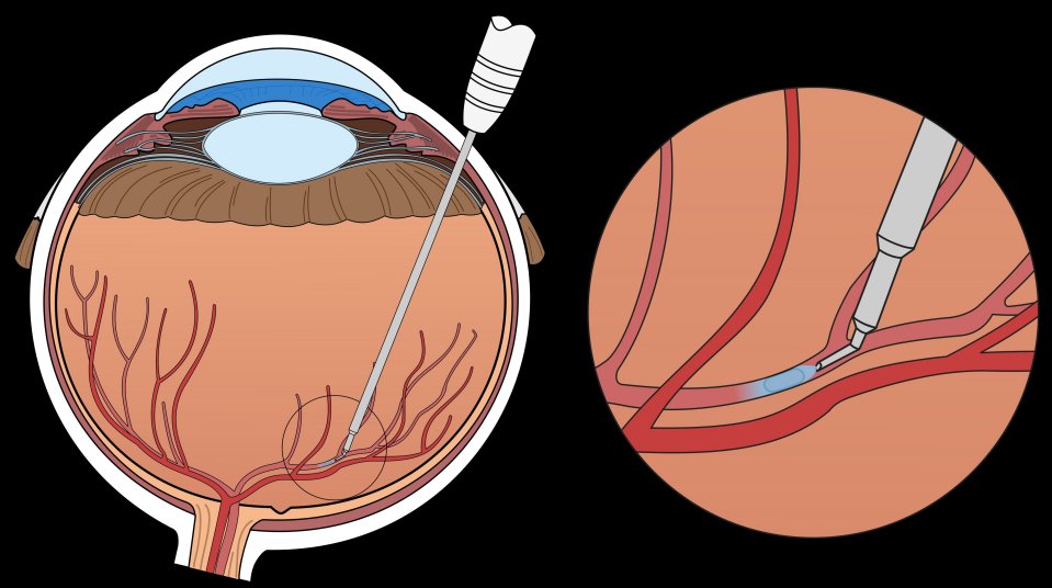 Rob-cirurgio opera veia dentro do olho e evita cegueira