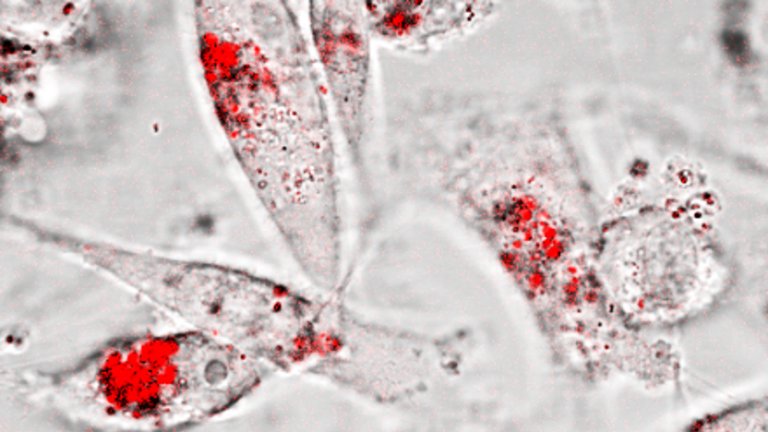 Nanopartculas destroem cncer sem precisar de medicamento