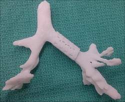 Pea feita em impressora 3D salva vida de beb