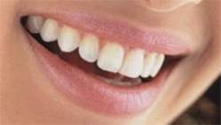Estudo confirma relao entre periodontite e aterosclerose