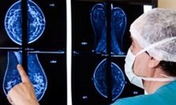 Falso-positivo em mamografia aumenta risco de cncer real