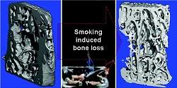Cientistas descobrem como cigarro enfraquece os ossos
