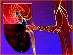 Denervação renal trata hipertensão resistente a medicamentos