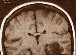 Novo tipo de epilepsia  descoberto por mdicos da Unicamp