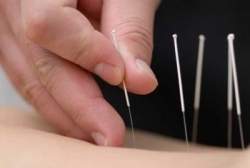 Estudo mostra mecanismos moleculares dos benefcios da acupuntura