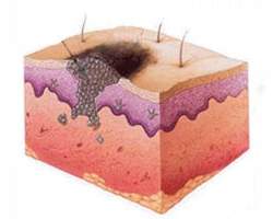 Alteraes epigenticas e estresse oxidativo ajudam a explicar cncer de pele
