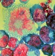 Descoberto esconderijo do HIV dentro do corpo humano