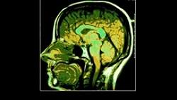 USP estuda estimulao cerebral com eletricidade contra a depresso