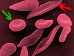 Fármaco brasileiro mostra bons resultados contra anemia falciforme