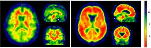 Não é apenas amiloide: Alzheimer depende de fator que pode ser prevenido