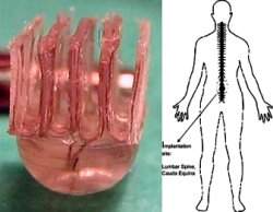 Implante espinhal permite exercitar membros paralisados