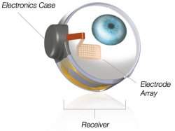 Olho binico comea a ser implantado em pacientes