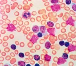 Clulas associadas  leucemia so encontradas em pessoas saudveis
