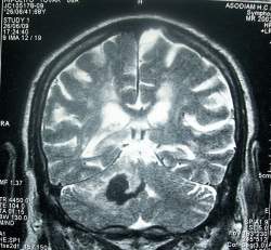 Exame dos olhos supera ressonncia magntica no diagnstico de derrame cerebral