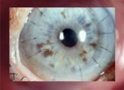 Brasileiros desenvolvem tcnicas inditas para tratamento dos olhos