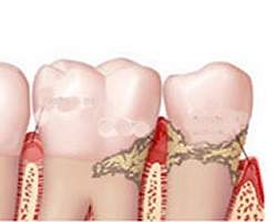 Problemas nas gengivas aumentam nveis de colesterol ruim