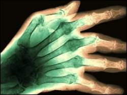 Protena da artrite pode proteger contra Alzheimer, diz estudo