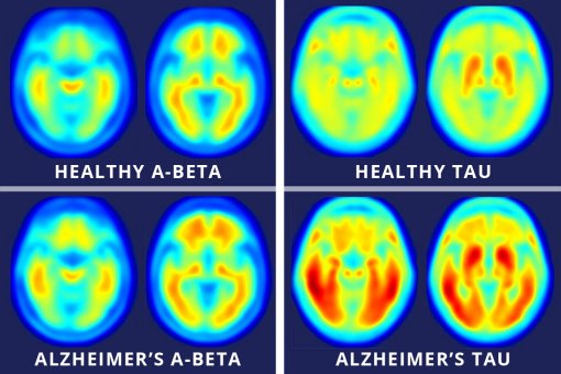 Protena tau explica Alzheimer melhor que beta-amiloide