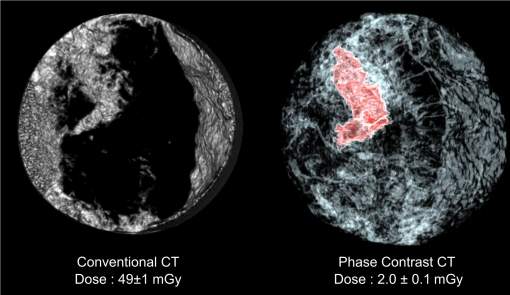 Mamografias podero ser feitas com 25 vezes menos radiao