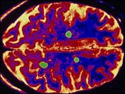 Regeneração do cérebro usa células-tronco contra esclerose múltipla