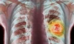 Temperatura da respirao pode identificar cncer de pulmo