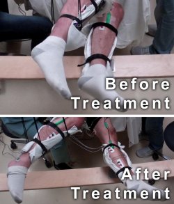 Pacientes com paralisia movem as pernas sem cirurgia