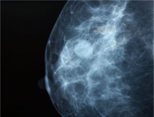 Efeito Angelina Jolie sobre exames genéticos para câncer de mama