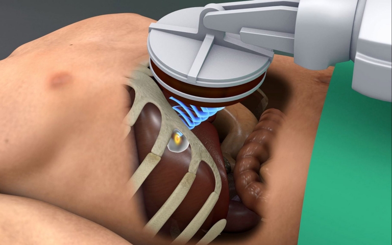 Ultrassom focaliza e destri tumor em tempo real