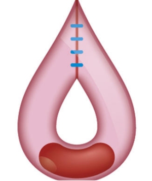 Trombose ou hemorragia: O dilema dos anticoagulantes nas cirurgias