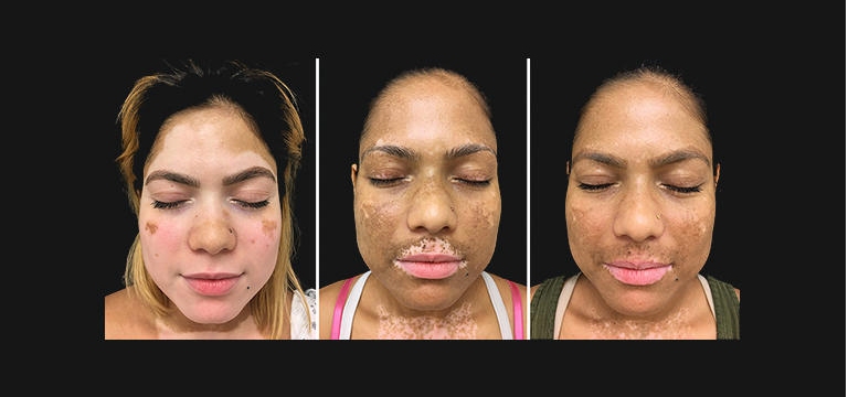 Vitiligo é virtualmente eliminado com terapia combinada