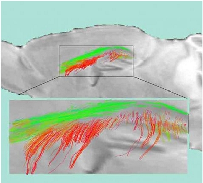 Pericitos: Novos suspeitos de causar Alzheimer e outras demncias