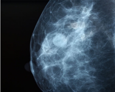 Quimioterapia  desnecessria em 70% das pacientes com cncer de mama inicial