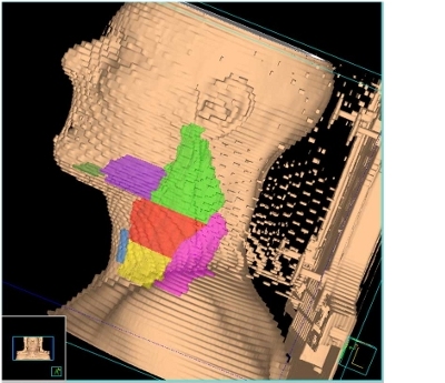 Nova radioterapia para cncer cerebral preserva funo cognitiva