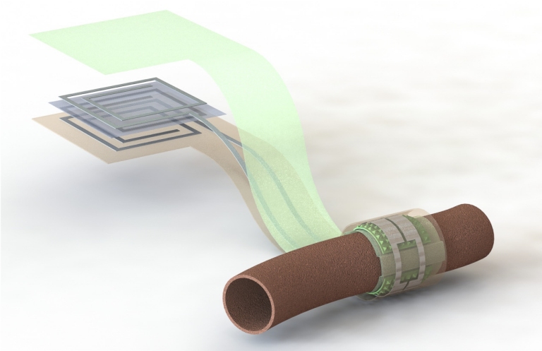 Sensor biodegradável monitora artérias para evitar novas cirurgias