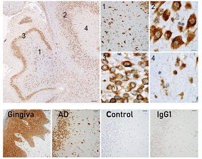 Finalmente descobrimos o que causa o Alzheimer?