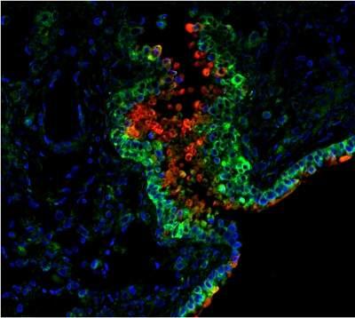 Bactérias do intestino podem prever câncer colorretal