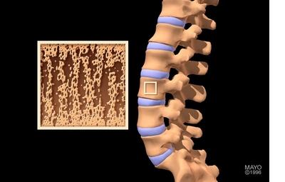 Osteoporose: Negligenciar preferncias dos pacientes aumenta taxa de insucesso