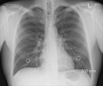 Como salvar mais vidas nos casos do cncer de pulmo?
