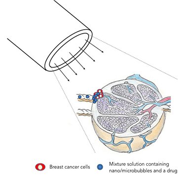 Metstases do cncer de mama so destrudas usando ondas sonoras