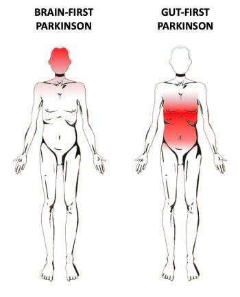 A doena de Parkinson comea no crebro ou no intestino?