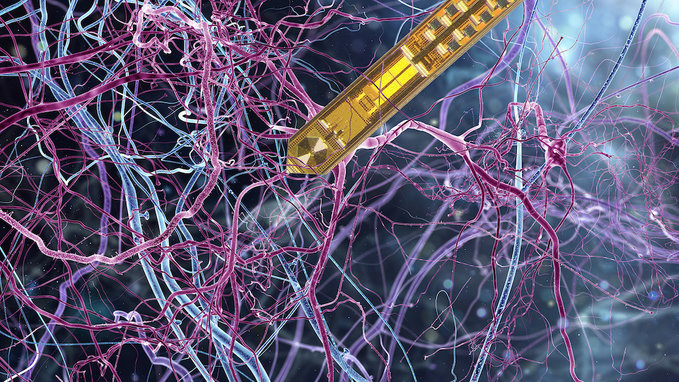 Criado aparelho de ressonncia magntica implantvel