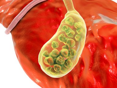 Pedra na vescula: Clculos podem causar dor ou serem assintomticos