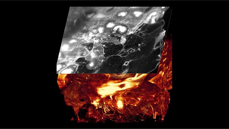 Bipsia de cncer feita em 3D vai revolucionar patologia