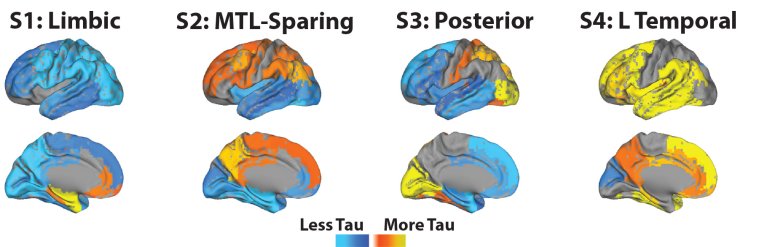 Descobertos quatro tipos diferentes de Alzheimer